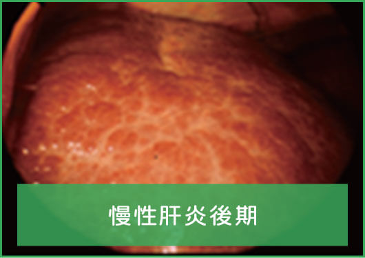 慢性肝炎後期