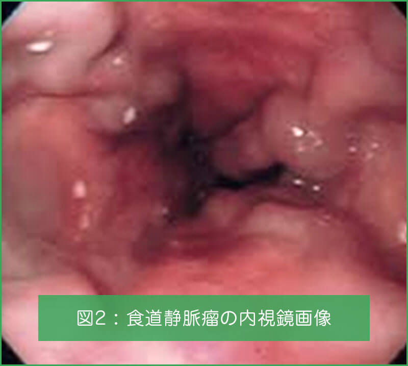 食道静脈癌の内視鏡画像
