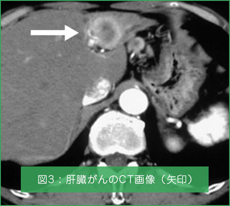 肝臓がんのCT画像