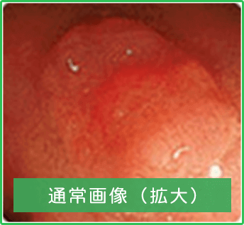 大腸画像1