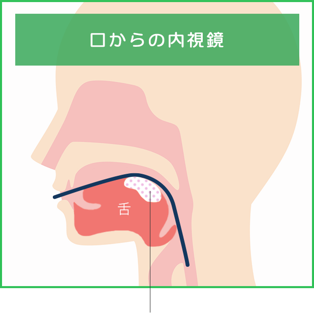 口からの内視鏡
