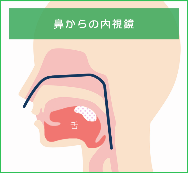 鼻からの内視鏡